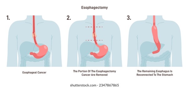 Esophagectomy. Partial excision of the esophagus. Surgical procedure of gullet recession or removement. Esophageal cancer treatment. Flat vector illustration