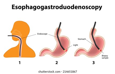 Esophagogastroduodenoscopy is a diagnostic procedure. Endoscope is a long, flexible, lighted tube. The endoscope is guided through the patient's mouth and throat, then through the esophagus, stomach.