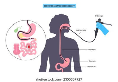 Esophagogastroduodenoscopy medical poster. Diagnostic endoscopic minimally invasive procedure. Visualization of the esophagus, stomach, and proximal duodenum. Gastroenterology flat vector illustration