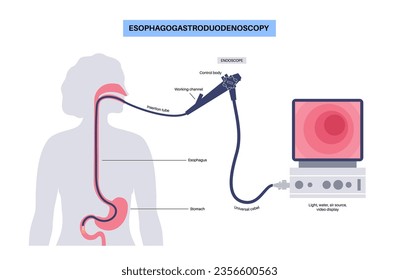 Esophagogastroduodenoscopy medical poster. Diagnostic endoscopic minimally invasive procedure. Visualization of the oropharynx, esophagus, stomach, and proximal duodenum. Gastroenterology flat vector