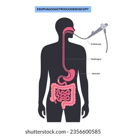 Esophagogastroduodenoscopy medical poster. Diagnostic endoscopic minimally invasive procedure. Visualization of the oropharynx, esophagus, stomach, and proximal duodenum. Gastroenterology flat vector