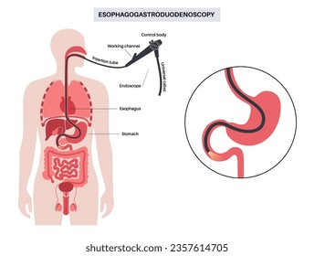 Esophagogastroduodenoscopy medical poster. Diagnostic endoscopic minimally invasive procedure. Visualization of the oropharynx, esophagus, stomach, and proximal duodenum. Gastroenterology flat vector