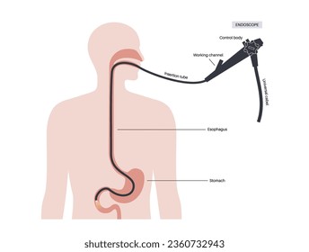 Esophagogastroduodenoscopy medical poster. Diagnostic endoscopic minimally invasive procedure. Visualization of the oropharynx, esophagus, stomach, and proximal duodenum. Gastroenterology flat vector