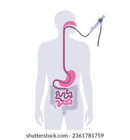 Esophagogastroduodenoscopy medical poster. Diagnostic endoscopic minimally invasive procedure. Visualization of the oropharynx, esophagus, stomach, and proximal duodenum. Gastroenterology flat vector