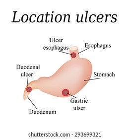 Esophagus ulcer affected. Ulcer of esophagus. Stomach ulcer affected. Gastric ulcer. Duodenum ulcer affected. Duodenal ulcer. Vector illustration on a background of isolation.