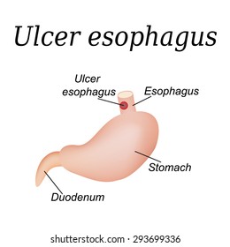 Esophagus ulcer affected. Ulcer of esophagus. Vector illustration on isolated  background.