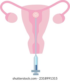 ET Embryo Transfer vector illustration. Perfect for presenting anything about reproduction, insemination or ivf.