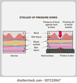 Etiology Of Pressure Sores. Vector Illustration.