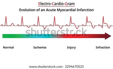 Evolution of an Acute Myocardial Infarction - Vectors and Illustrations for Medical Purposes