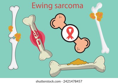 Ewing sarcoma,bone cancer,cancer that develops in the body’s supporting tissues,extraosseous,pelvis bone (hips),thigh bone (femur),shin bone (tibia), tumor cell with hip femur gross leg bone pain 