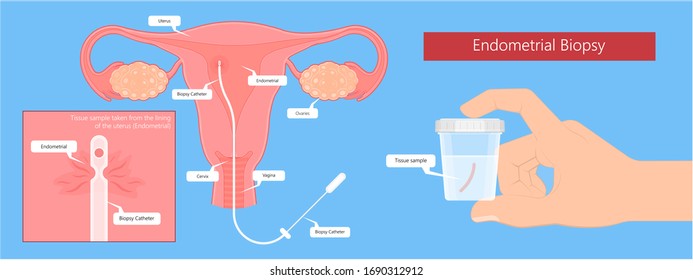 Endometrial biopsy examination uterus procedure IVF In Vitro Fertilization diagnostic screen acute pelvic inflammation cervix lab check infertility pap smear and vagina D&C 