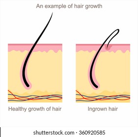 An example of the growth of healthy hair and ingrown hair.