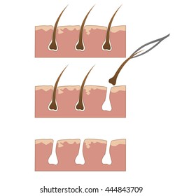 Example of hair removal from skin with tweezers