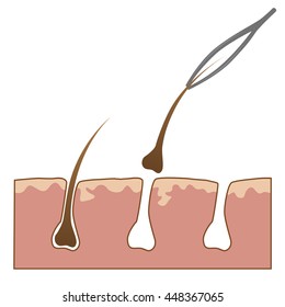 Example of hair removal from skin with tweezers