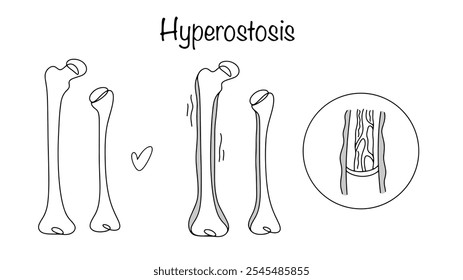 Crecimiento excesivo de tejido óseo, que puede ser una enfermedad independiente o un síntoma de alguna otra enfermedad. Los llamados huesos tubulares se ven afectados con mayor frecuencia. Hueso sano e hiperostosis.