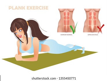 exercise plank can not be with the divergence of abdominal muscles diastasis