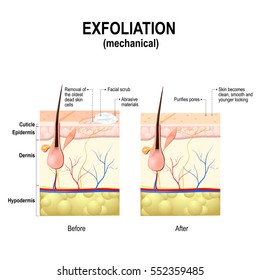 Exfoliation Or Peeling Is A Cosmetic Procedure (physically Scrubbing) To Remove Impurities From The Skin, Unclog The Pores And Exfoliate Dead Skin Cells. Cross-section Of A Skin Layers.