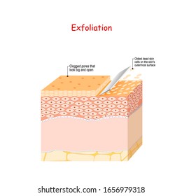 Exfoliation. Peeling Or Physically Scrubbing. Skin Care. Close Up Of Peeling Procedure. Cosmetology. Exfoliation Is Removal Of The Old Dead Cells On The Skin's Outer Surface. Cross-section Skin Layers