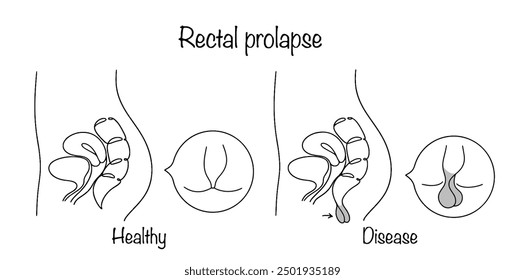 Exit to the outside of all layers of the rectum through the anus. Proctological disease. Hand drawn disease. Vector illustration.
