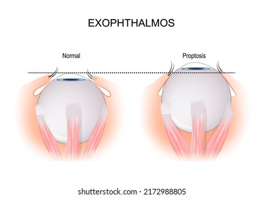 Exophthalmos is a bulging of the eye anteriorly out of the orbit. comparison and difference between normal eyeball and disorder that caused by Grave's Disease. vector illustration