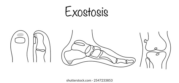 Exostosis. A tumor-like formation of bone tissue that forms on the surface of the bone and leads to joint deformation. A simple line illustration for use in the medical field. 