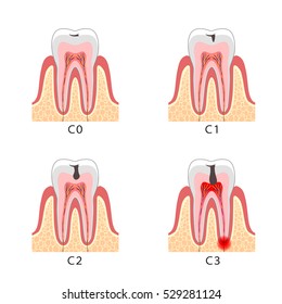Explanation of decayed teeth illustration
