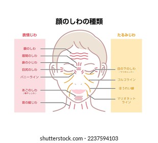 Expression wrinkles and Aging wrinkles ( female face ) vector illustration translation: forehead lines, crow's feet, bunny lines, marionette lines, neck wrinkles, frown lines, tear troughs