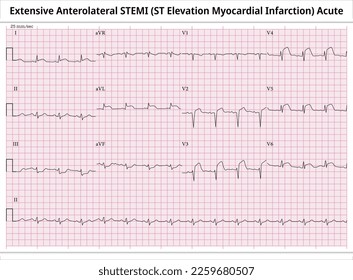 Extensive anterolaterale STEMI (ST-Elevation Myocardial Infarction) akut - ECG Papier 12 Blei - Vektormedizinische Illustration