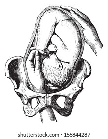 External cephalic version, How to make the feet so as to fondle the child on its previous plan, vintage engraved illustration. Usual Medicine Dictionary by Dr Labarthe - 1885.