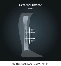 Fixação externa para fraturas do lado ósseo	
radiografia