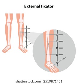 Fixação externa para fraturas do lado ósseo