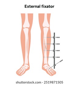 Fixação externa para fraturas do lado ósseo