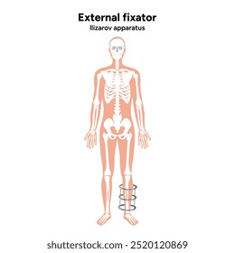 Fijador externo, aparato de lizarov para humanos