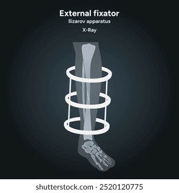 Fijador externo, radiografía del aparato de Llizarov