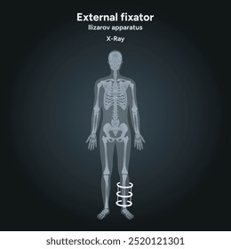 Fijador externo, radiografía del aparato de Llizarov