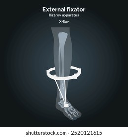 Fixador externo, aparelho llizarov, perna de raios X