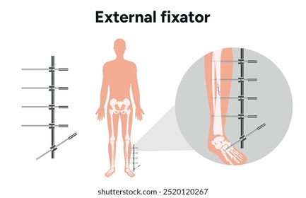 Fijador externo, zoom del aparato de Llizarov