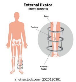 Fixador externo, zoom de aparelhos de llizarov