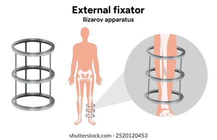 Fijador externo, zoom del aparato de Llizarov