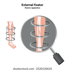 Fijador externo, zoom del aparato de Llizarov