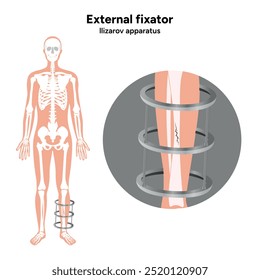 Fijador externo, zoom del aparato de Llizarov