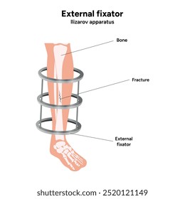 Fixador externo, llizarov aparato perna de zoom