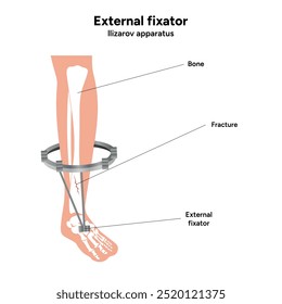 Fixador externo, llizarov aparato perna de zoom
