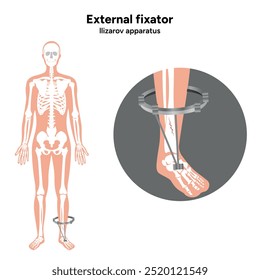 Fijador externo, zoom del aparato de Llizarov