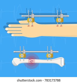 External Fixator treatment broken bone injury accident fracture surgical doctor patient hand arm emergency anatomy sick x-ray tool equipment first aid hospital clinical care health crash injury