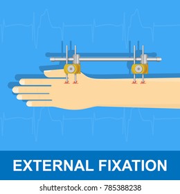 External Fixator treatment broken bone injury accident fracture surgical doctor patient hand arm emergency anatomy sick x-ray tool equipment first aid hospital clinical care health crash injury