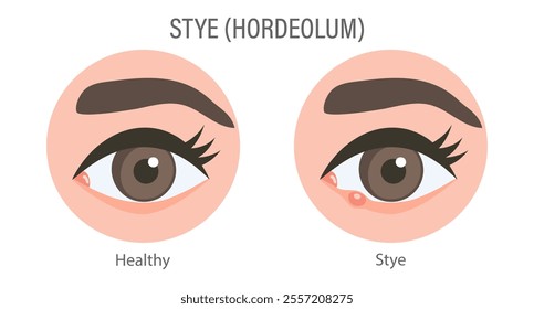 External and internal stye of the eye. Medical concept of stye, eye pain, bacterial infection, eye disease. Flat illustration, infographic banner	
