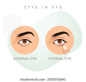 External and Internal Stye in the Eyes - Stock Illustration as EPS 10 File