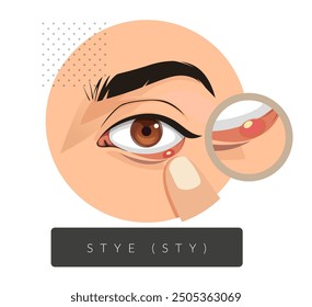 External and Internal Stye in the Eyes - Stock Illustration as EPS 10 File