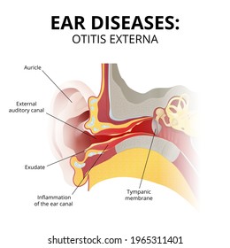 äußere Otitis, Entwicklung und Symptome der Krankheit, die Struktur des menschlichen Ohrs in einem Abschnitt